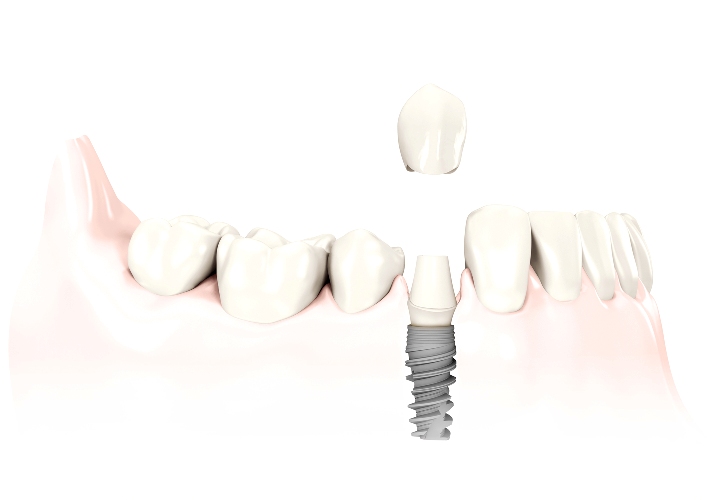 Sostituzione dente singolo