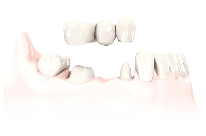 Esempio di ponte su denti naturali